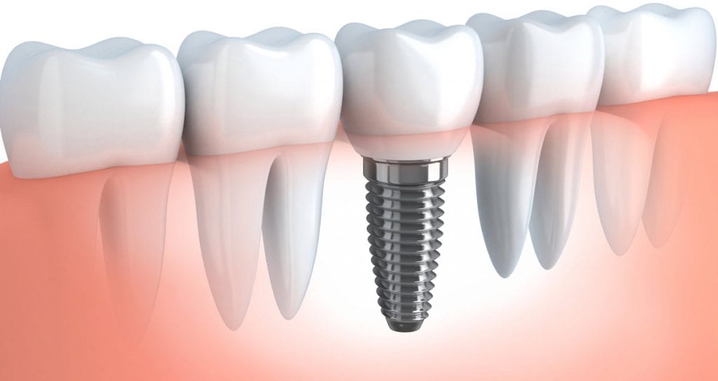 implantologia dentale totale